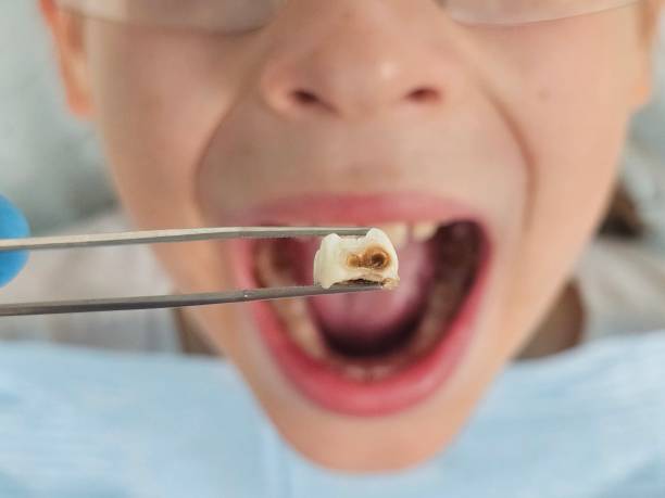 Best Emergency Tooth Extraction in Uniontown, PA